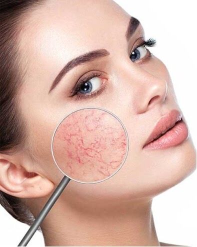 Zamykanie naczynek elektokoagulacja