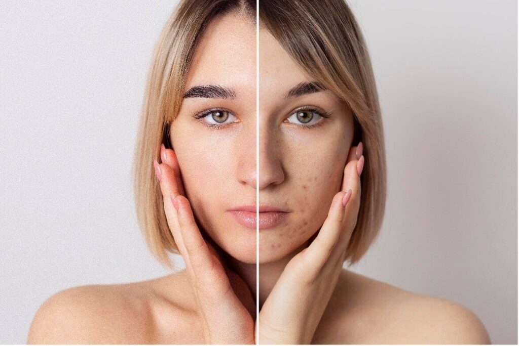 Jak pozbyć się trądziku