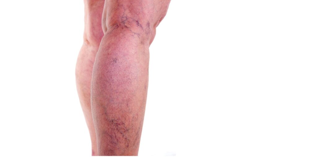 Żylaki a masaż i fizjoterapia