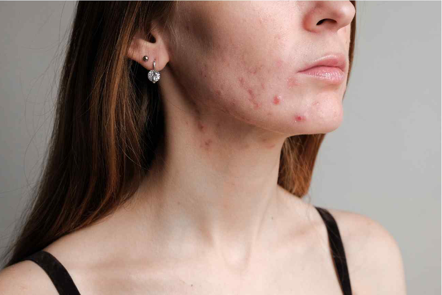 rądzik leczenie w Holispace