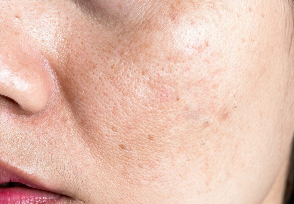 Odmładzanie okolic oka - Retix C Eye