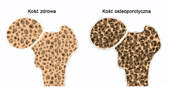 Osteoporoza choroba kości