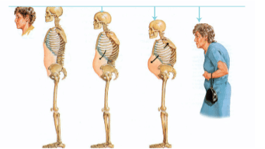 Osteoporoza choroba kości