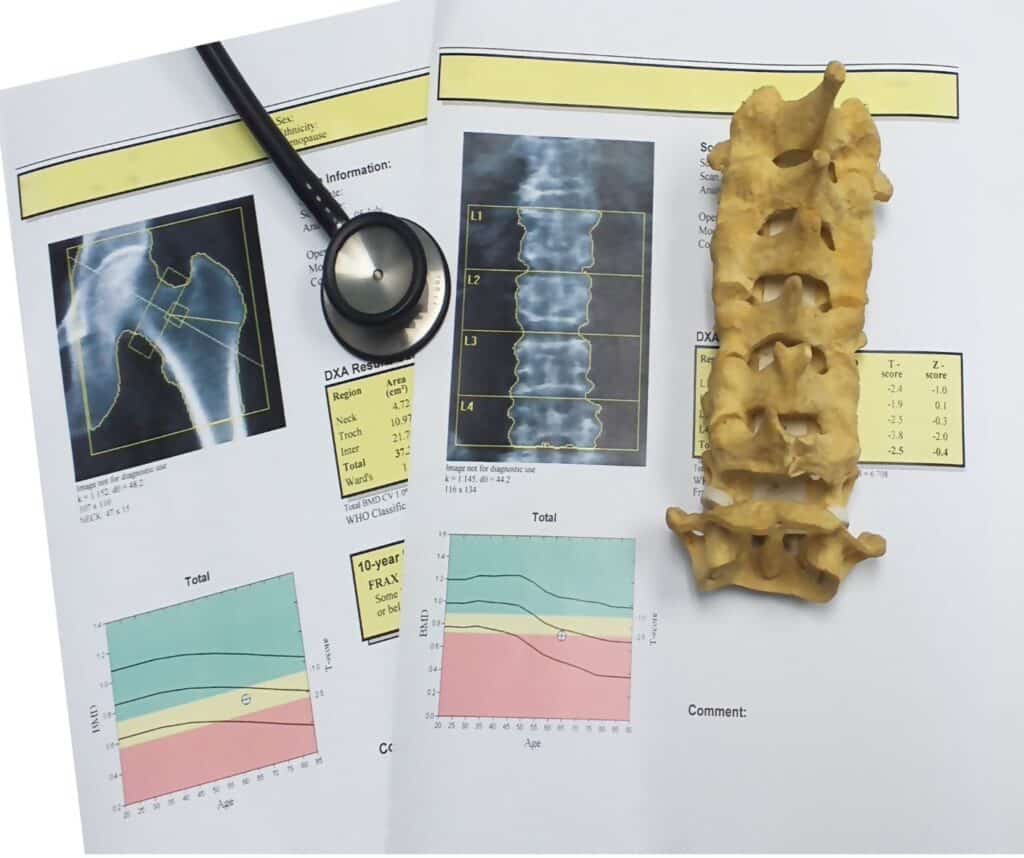 Fakty i mity o osteoporozie